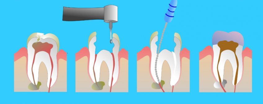 ENDOTONTI-KANAL TEDAVİSİ