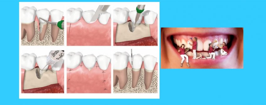 Periodontoloji diş eti hastalıkları
